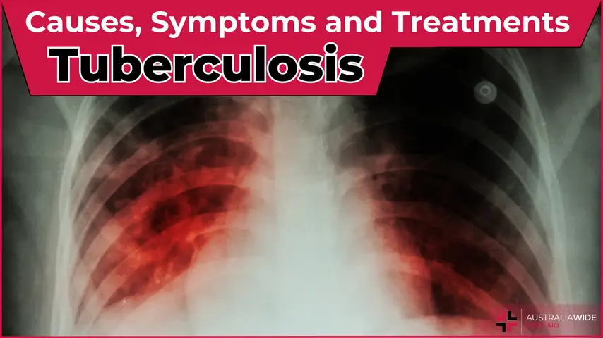 Tuberculosis article header